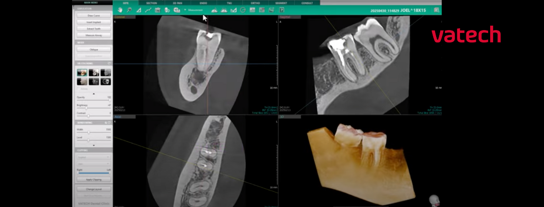 vatech cbct for endo