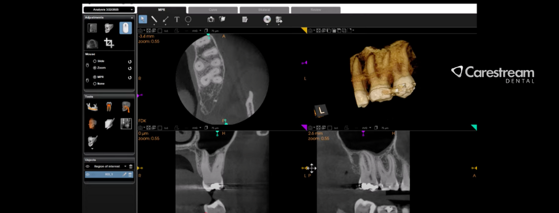 carestream cbct endo