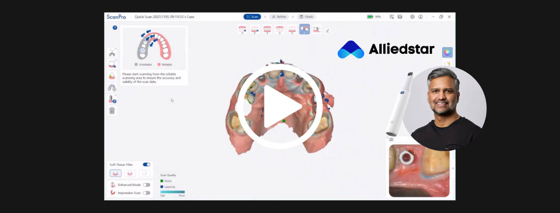 alliedstar scanpro implant workflow
